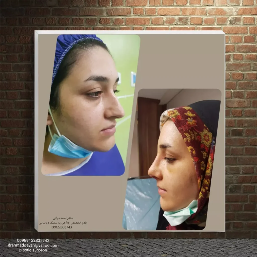 نمونه کار جراحی بینی استخوانی