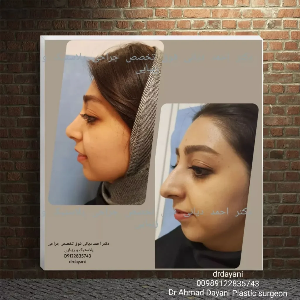 عمل بینی