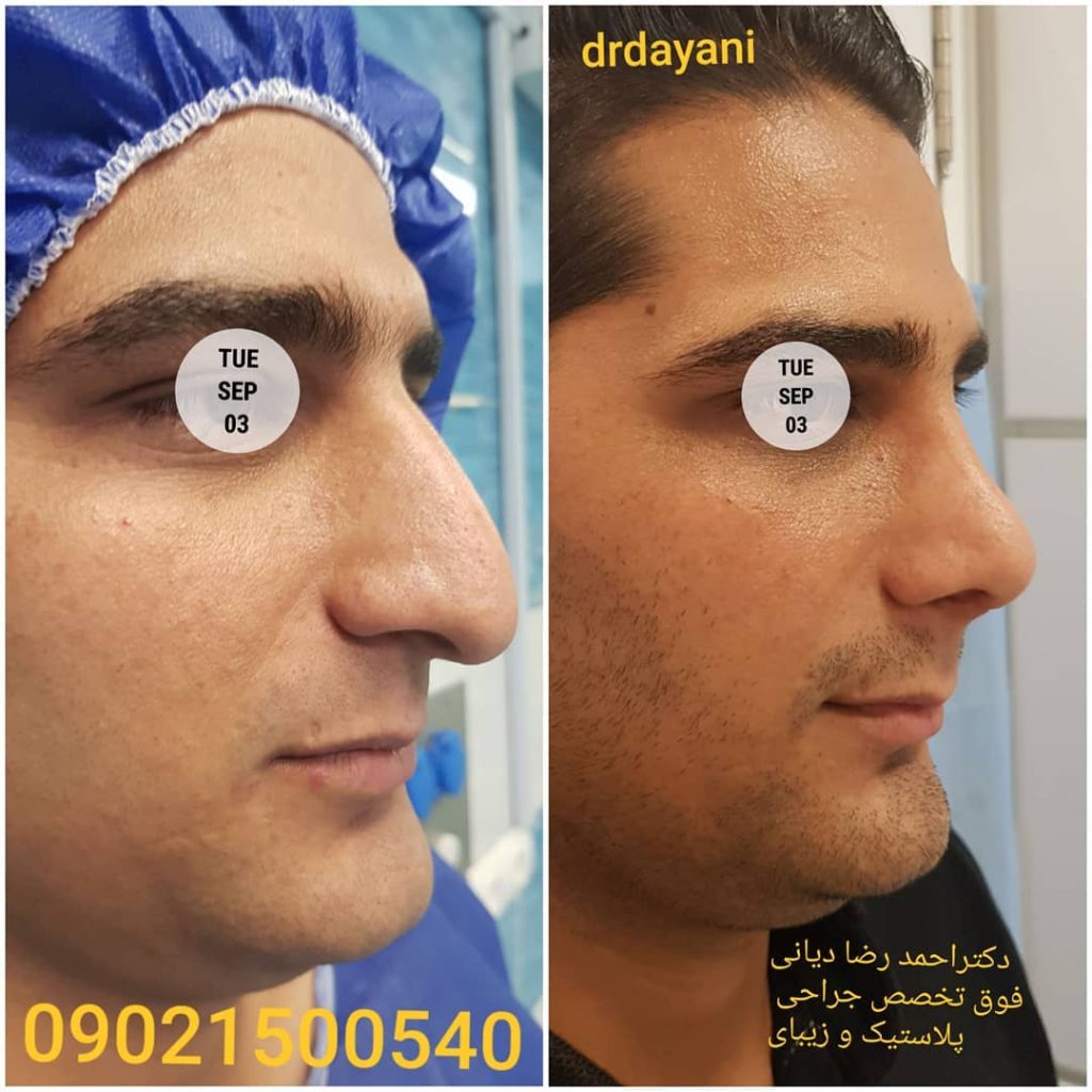 جراحی بینی
