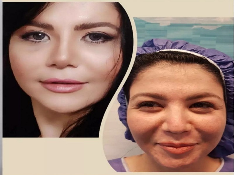 عمل بینی