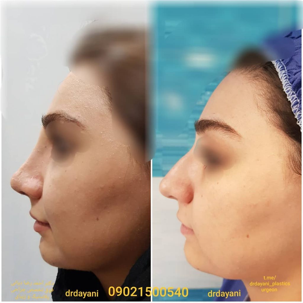 عکس قبل و بعد جراحی بینی
