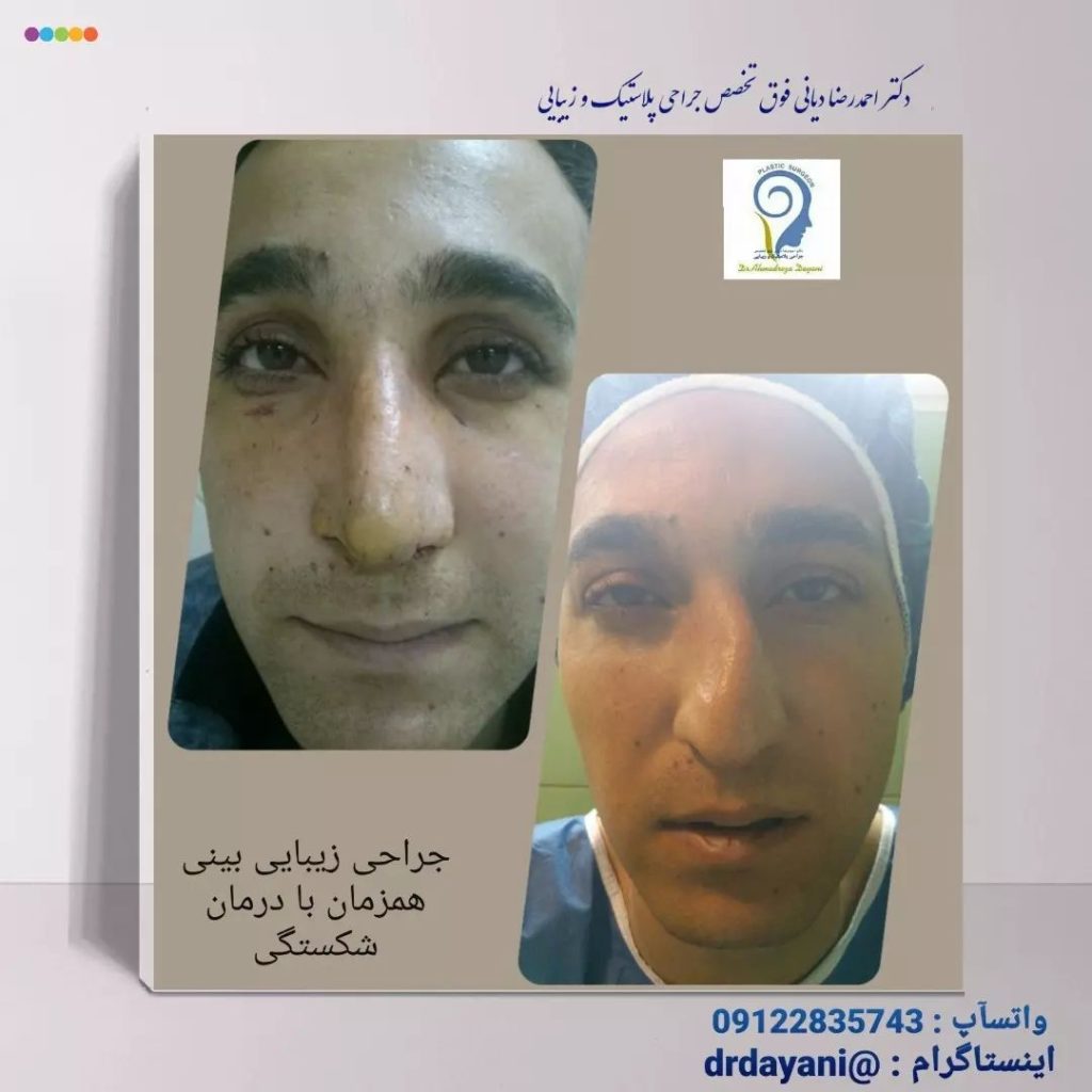 عکس جراحی بینی