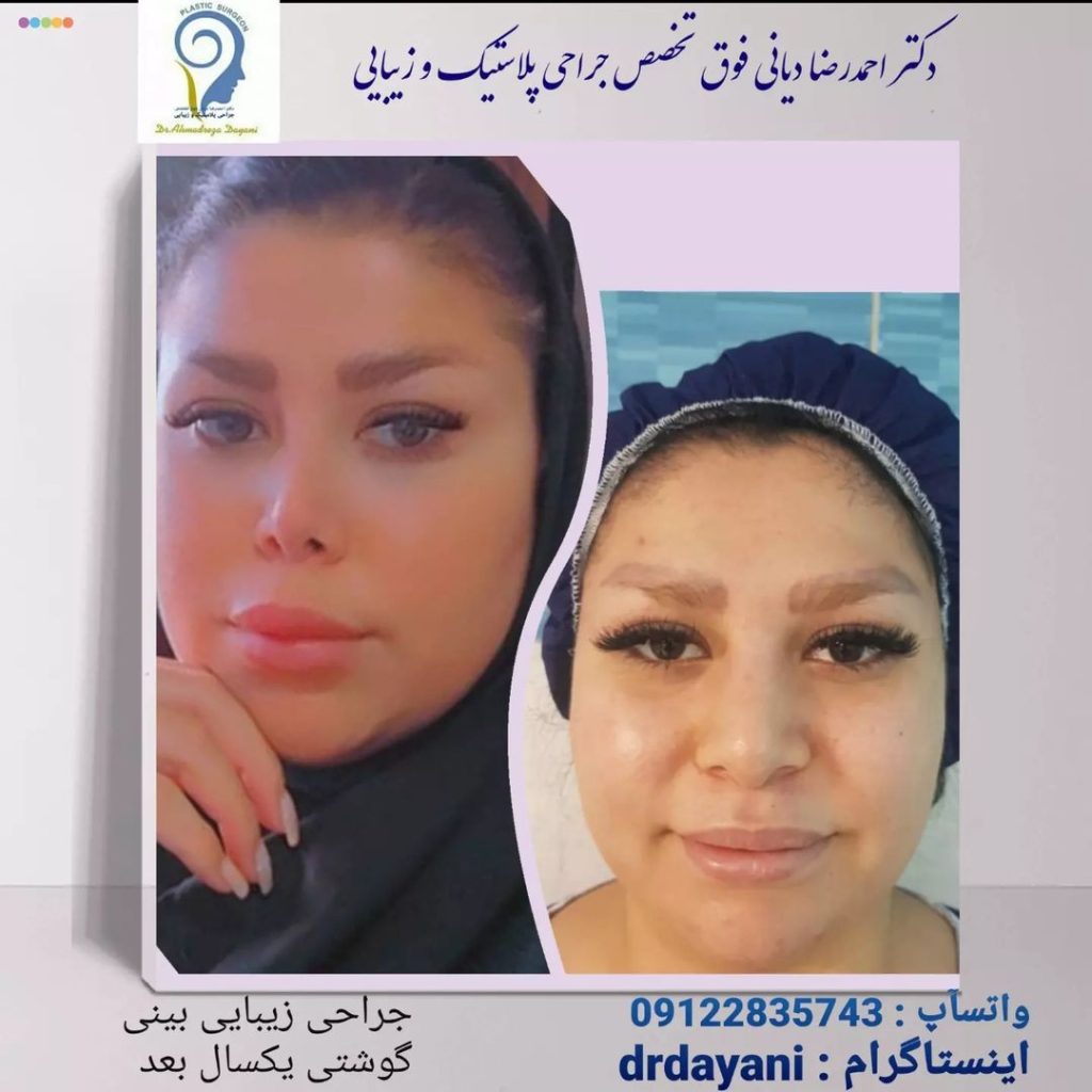 عکس جراحی بینی