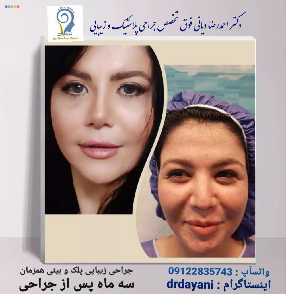 نمونه کار بهترین جراح بینی در زعفرانیه