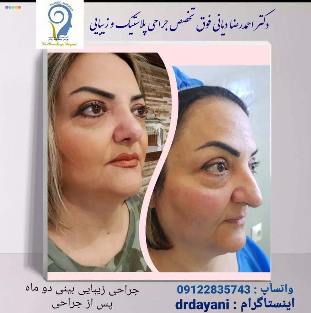 نمونه کار بهترین جراح بینی در زعفرانیه