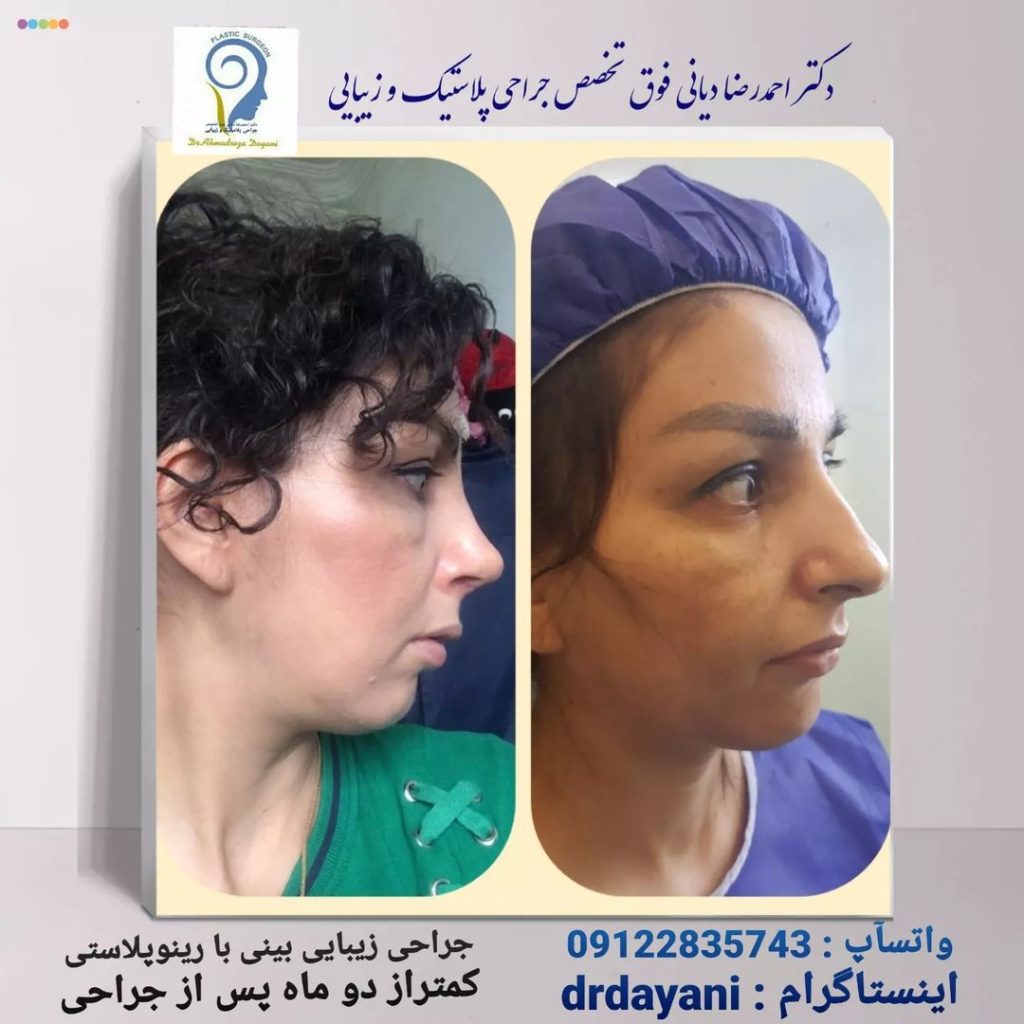 نمونه کار بهترین جراح بینی در زعفرانیه