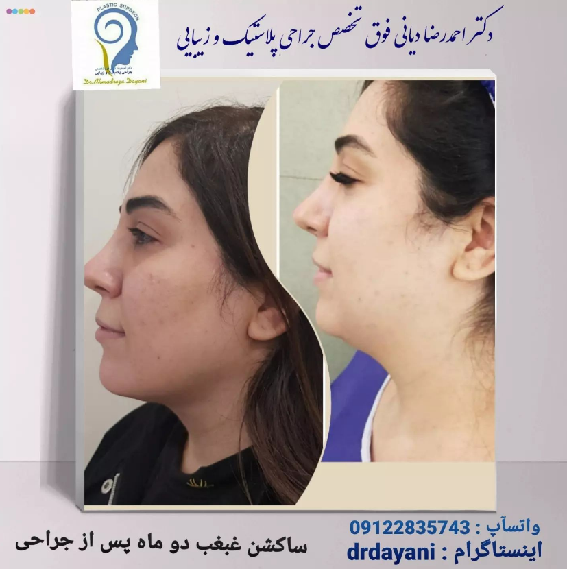 لیپوساکشن غبغب