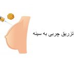 تزریق چربی سینه