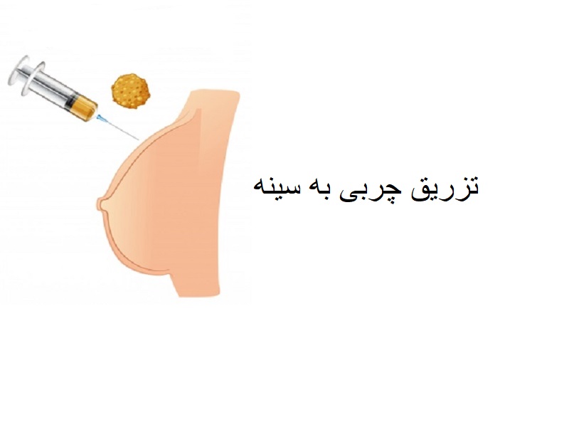 تزریق چربی سینه