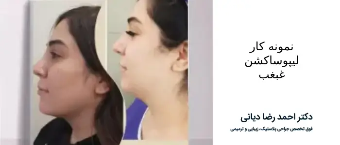 بهترین جراح لیپوساکشن غبغب در تهران