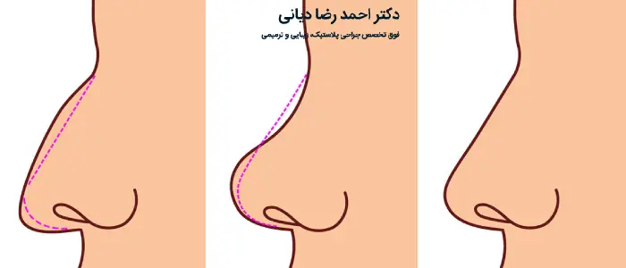 جراحی بینی استخوانی