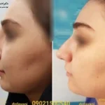 جراحی بینی استخوانی
