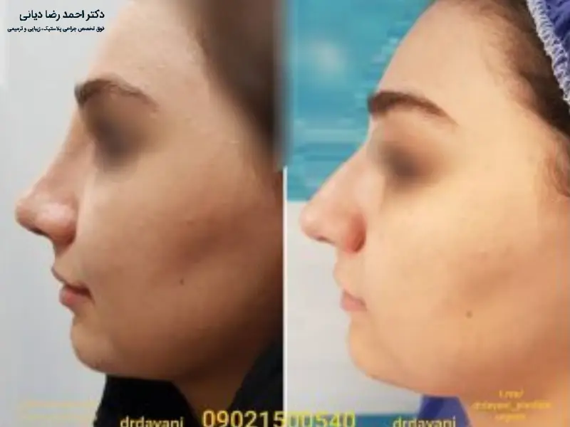 جراحی بینی استخوانی