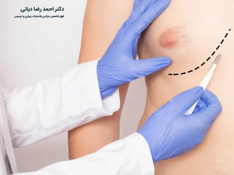 ژنیکوماستی چیست