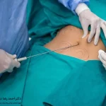 بهترین جراح لیپوساکشن در تهران