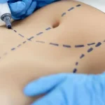 عوارض ابدومینوپلاستی