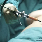 مراقبت های بعد از لیپوساکشن