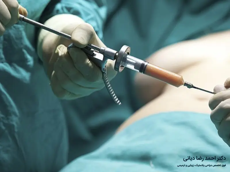 مراقبت های بعد از لیپوساکشن