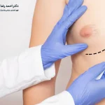 مراقبت های بعد از ژنیکوماستی