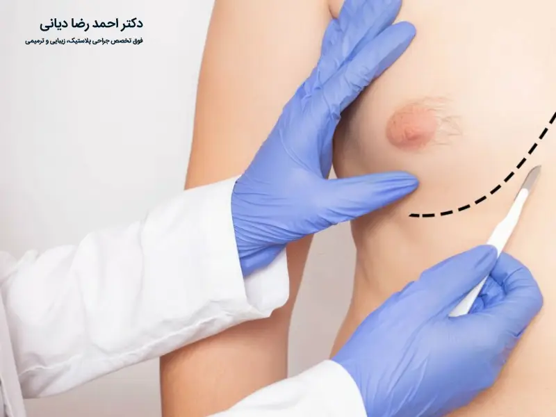 مراقبت های بعد از ژنیکوماستی