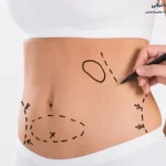 تفاوت لیپوماتیک با لیپوساکشن