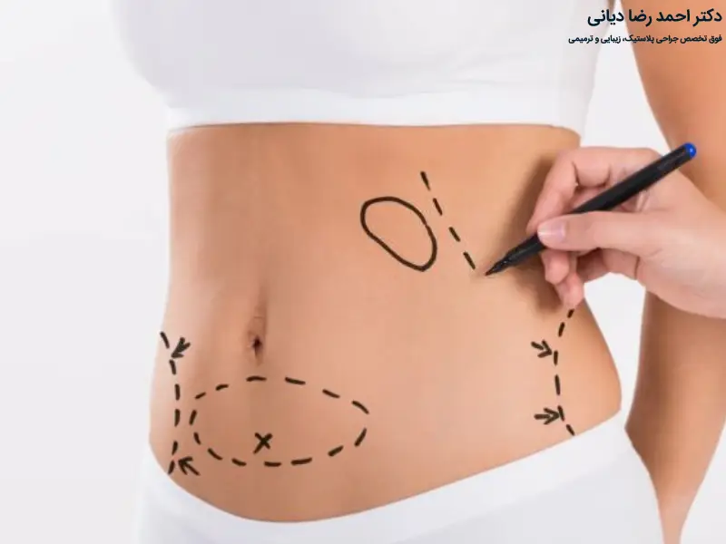 تفاوت لیپوماتیک با لیپوساکشن
