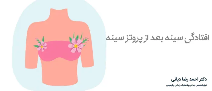 افتادگی سینه بعد از پروتز سینه