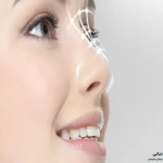 ورزش بعد از جراحی بینی