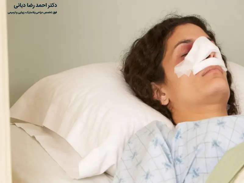 نحوه خوابیدن بعد از جراحی بینی