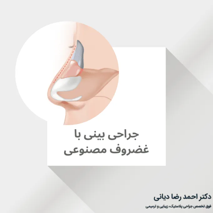 جراحی بینی با غضروف مصنوعی