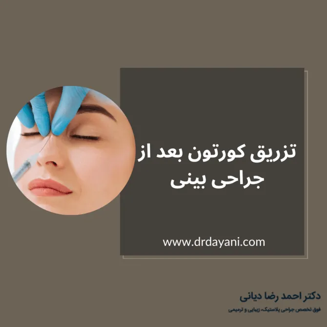 تزریق کورتون بعد از جراحی بینی