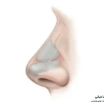 جراحی بینی با غضروف مصنوعی