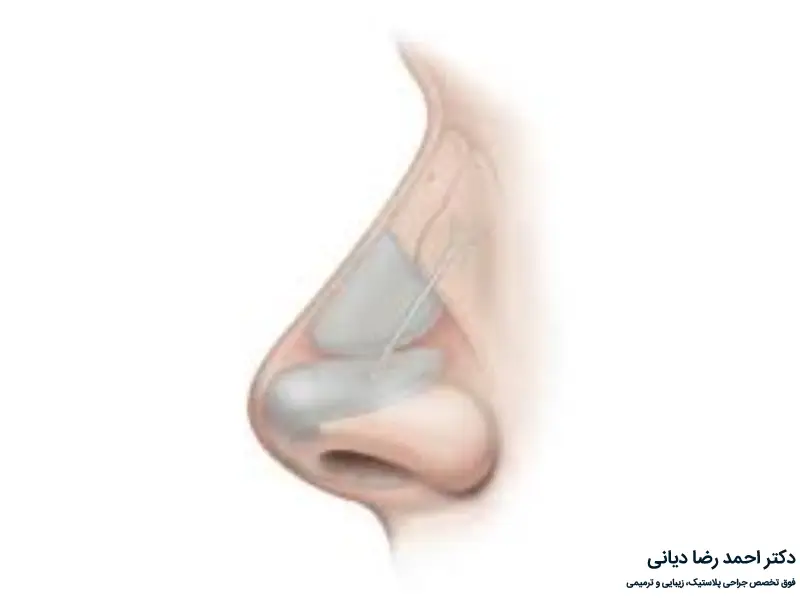 جراحی بینی با غضروف مصنوعی