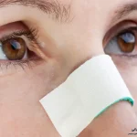 آلرژی و عمل بینی