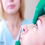 استحمام بعد از عمل بینی