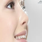 خونریزی بعد از عمل بینی