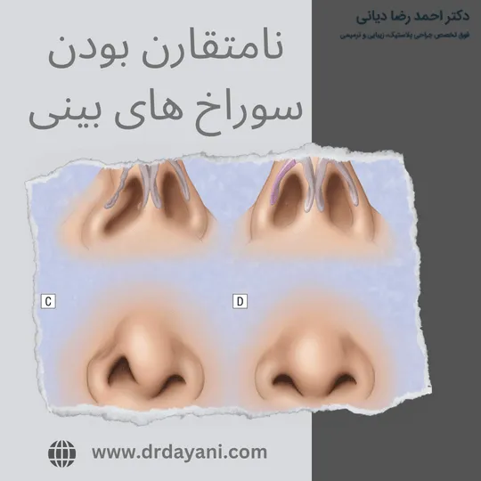 نامتقارن بودن سوراخ های بینی
