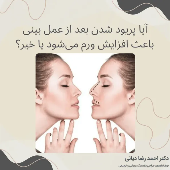 جراحی بینی در پریودی