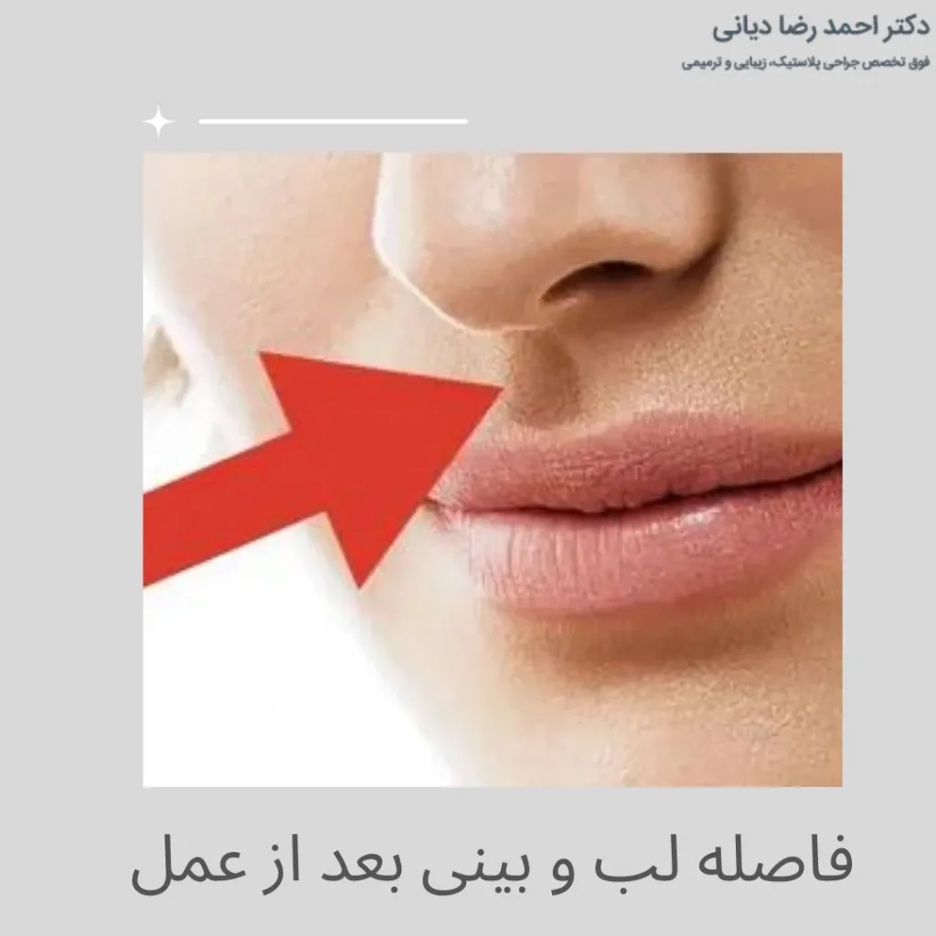 فاصله لب و بینی بعد از عمل