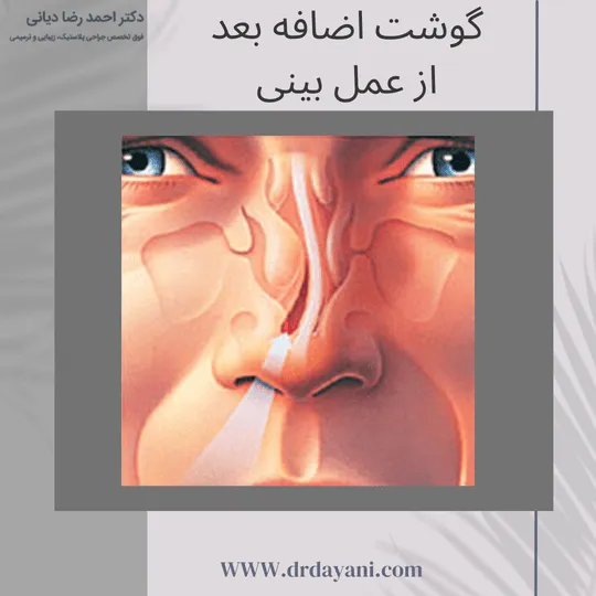 گوشت اضافه بعد از عمل بینی