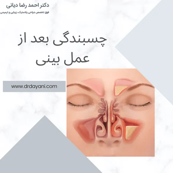 چسبندگی بعد از عمل بینی