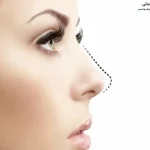 بالا نگه داشتن سر بعد از عمل بینی
