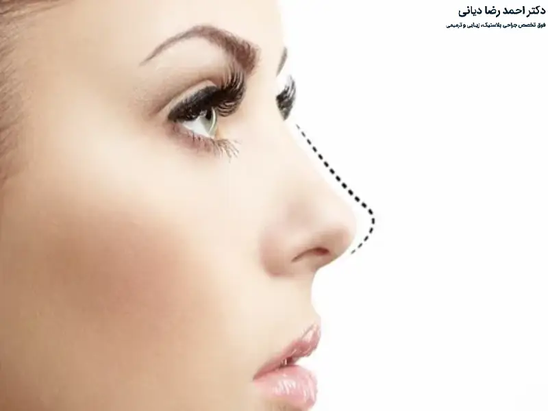 بالا نگه داشتن سر بعد از عمل بینی