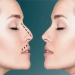 فاصله لب و بینی بعد از عمل