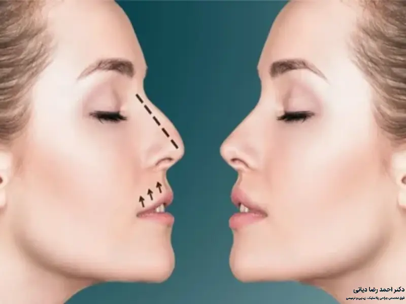 فاصله لب و بینی بعد از عمل