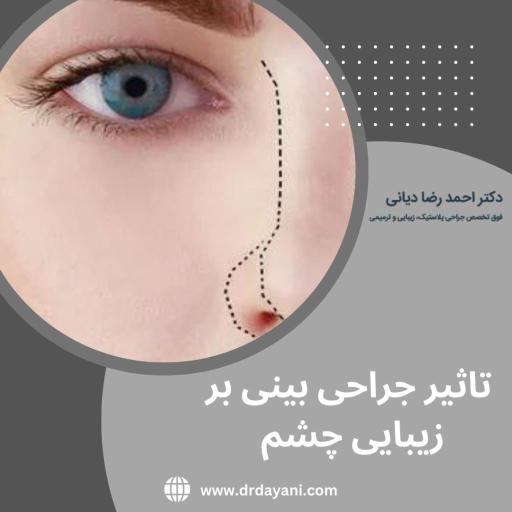 تاثیر جراحی بینی بر زیبایی چشم