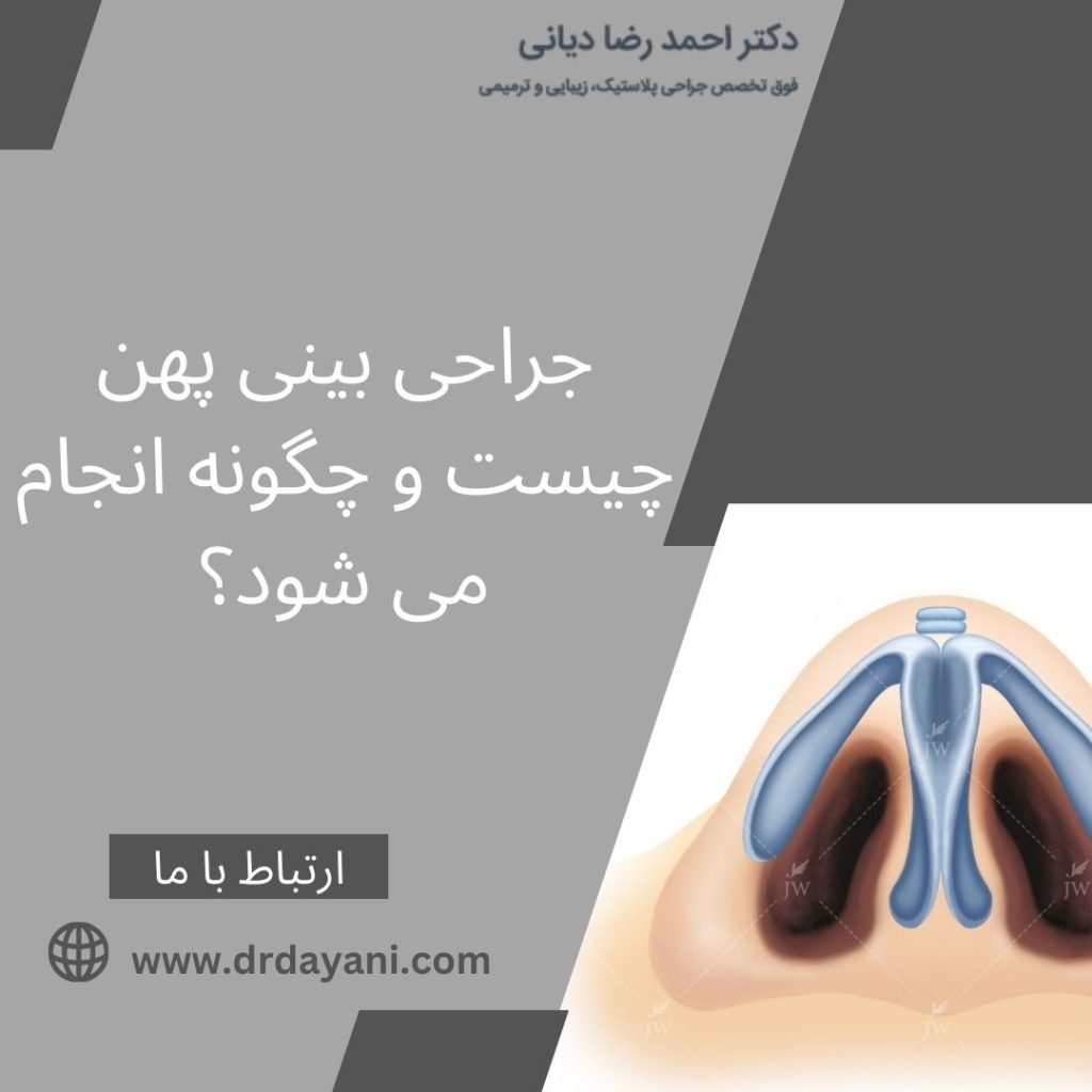 جراحی بینی پهن