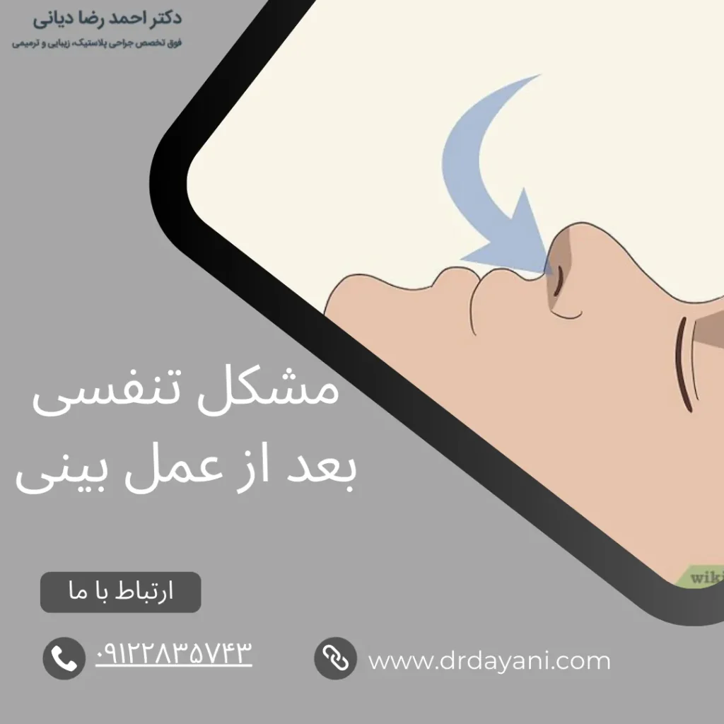 مشکل تنفسی بعد از عمل بینی